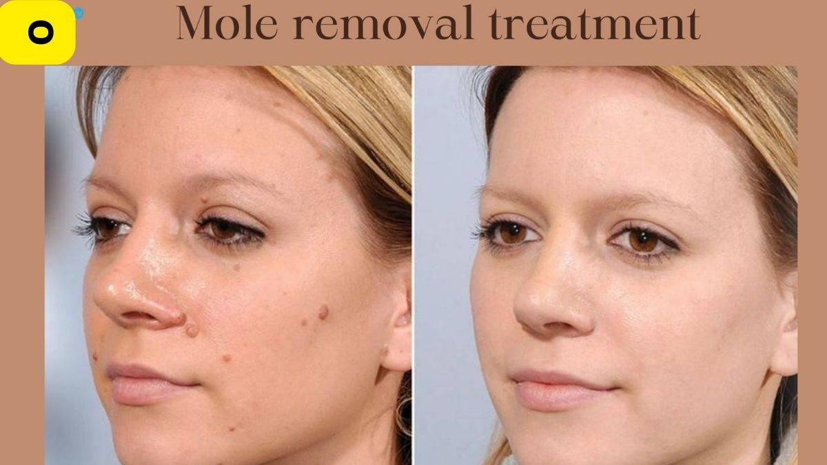 Moles Laser Treatment