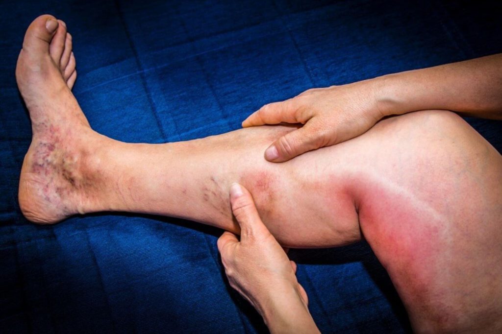 Blood Clot in Leg