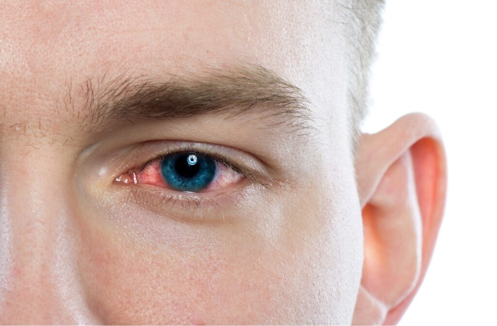 pink eye