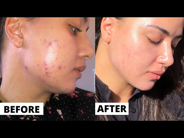 tretinoin journey